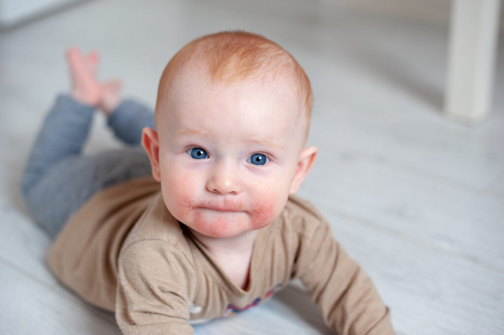 Eczéma atopique visage bébé